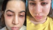 “Fillers Nahi Hai, Allergies Hai! Urfi Javed Opens Up About Swollen Face On Instagram 898232